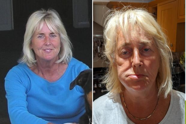 Mrs Walton before and after the surgery